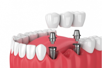 Ce sunt si de ce sunt recomandate implanturile dentare?