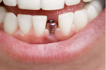 Ce poate oferi un implant dentar